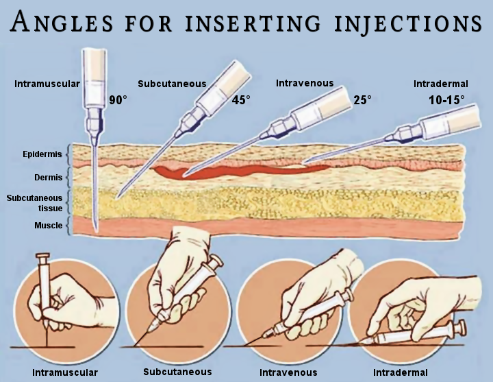 Angles for injections.png.