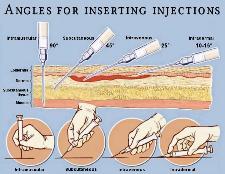 [DIAGRAM] Diagram Of Injection Sites